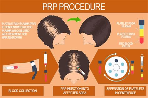 Finasteride And Minoxidil Hair Loss Treatment In Kl Cleo Clinic