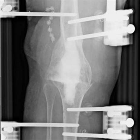 Anterior Lrs® External Fixator Placement After Tkr Removal And Joint