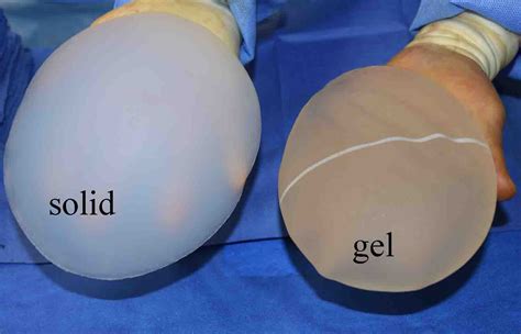 Plastic Surgery Case Study Replacement Of Ruptured Gel Buttock