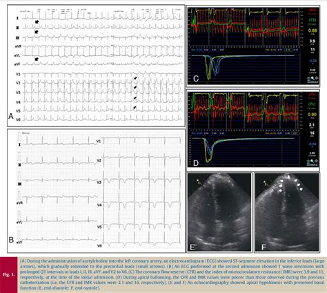 Figure 1 From Takotsubo Cardiomyopathy In Two Patients With Microvascular Angina Semantic Scholar