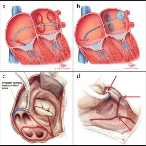 Isolation Of Pulmonary Veins Using Radiofrequency Ablation Catheter A Download Scientific