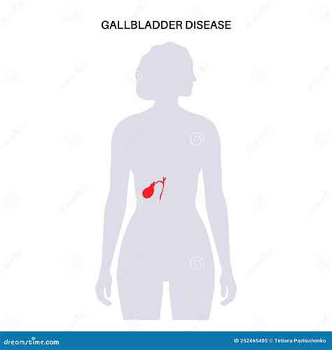 Gallbladder Diseases Infographics. Gallstone Disease, Cancer, Acute