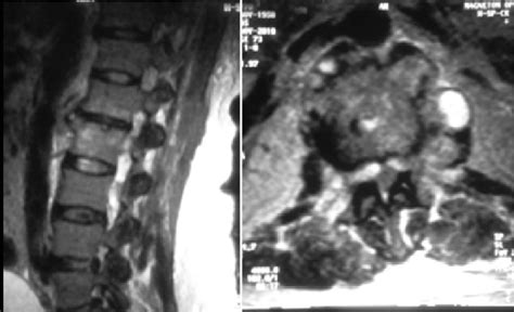 Mri Of The Lumbar Spine In T2 Sagittal View Showing A Hyperintense Download Scientific Diagram