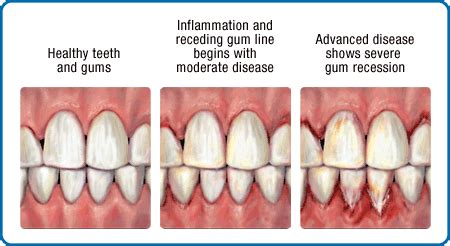 Why Do My Gums Bleed Mccloy Dental