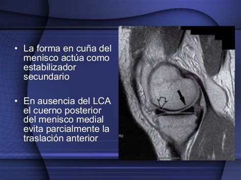 Biomecanica De Los Meniscos