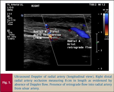 Figure 1 From When One Complication Begets Another A Case Report Of