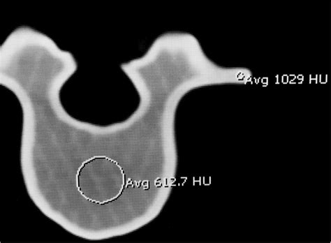 Under Ct The Lumbar Spine Model Demonstrates Hounsfield Units That Download Scientific Diagram