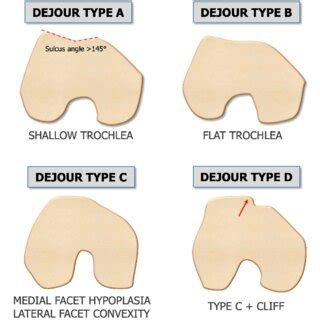 TT TG Distance A The Most Prominent Point Of Tibial Tuberosity TT