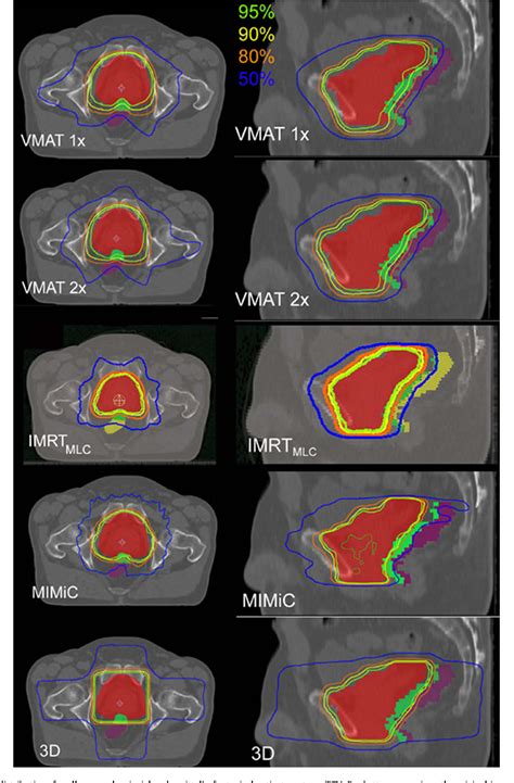 Volumetric Modulated Arc Therapy Vmat Vs Serial Tomotherapy Step