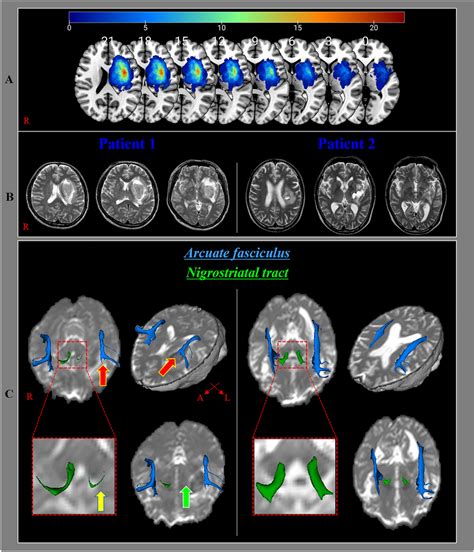 Results Of Diffusion Tensor Tractography For The Arcuate Fasciculus