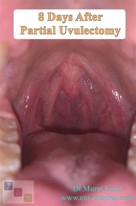 A Simple Partial Uvulectomy Technique Under Local Anesthesia For The