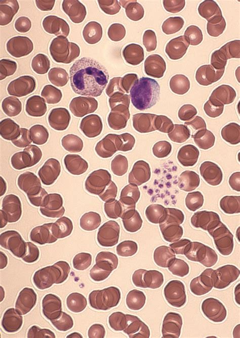 Blood smear of an EDTA sample showing activated lymphocytes and ...