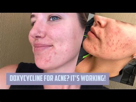 DOXYCYCLINE 4 12 Weeks Of Treatment Acne Update YouTube