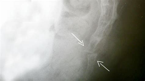 Tailbone Contusion - Coccyx Pain Bruised Tailbone Causes Symptoms ...