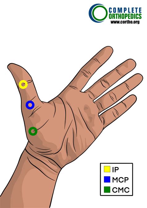 Scheduled Loss Of Use For Upper Extremities Complete Orthopedics