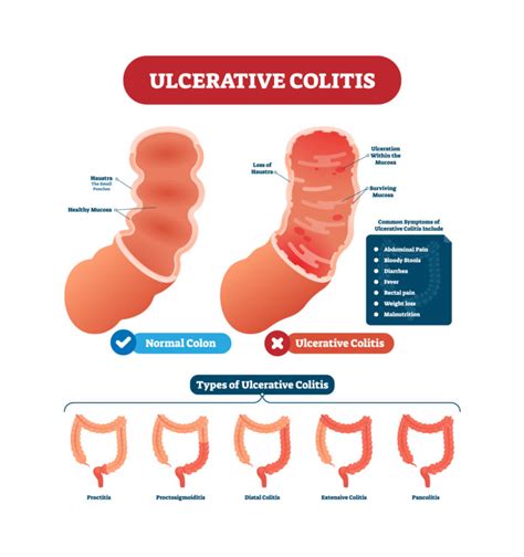 Ulcerative Colitis Treatment Christina Ong Paediatric