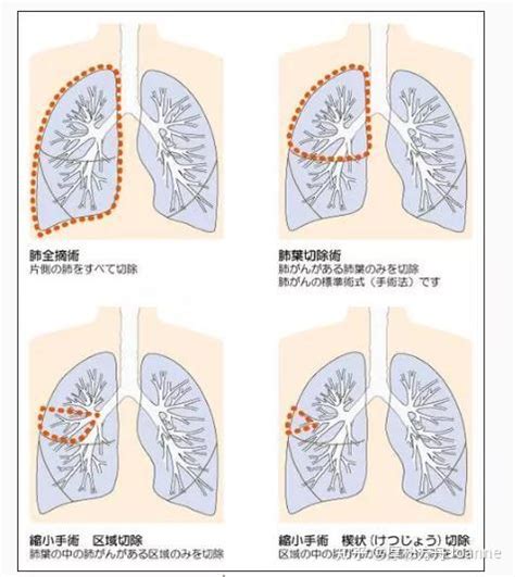 哪些肺癌患者适合手术，手术方式如何选择？肺癌专家全面解答 知乎