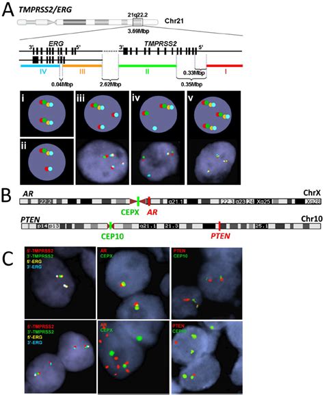 The Three Marker FISH Panel Including TMPRSS2 ERG Rearrangements AR