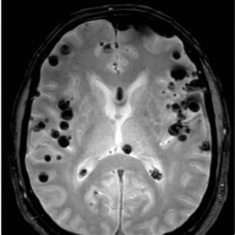 A Compression Bifrontal Supra And Infratentorial Pneumocephalus