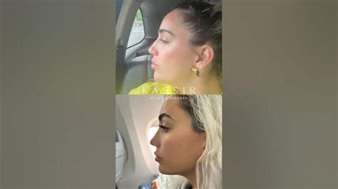 Nose Job Before And After Rhinoplastysurgeon Rhinoplastybeforeandafter Nosejobbeforeandafter