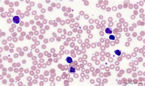 T Prolymphocytic Leukaemia Learnhaem Haematology Made Simple