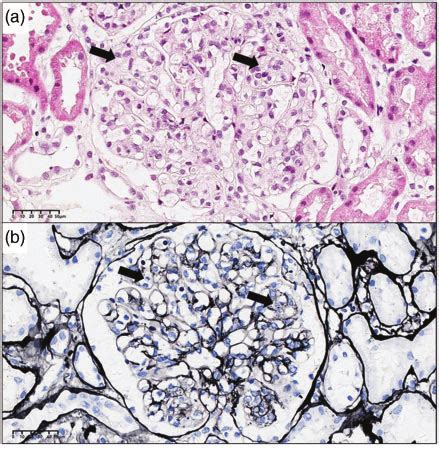 Representative Photomicrographs From A Renal Biopsy Taken From A