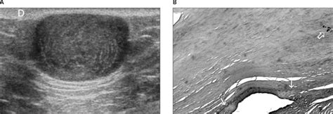 Subcutaneous Dermoid Cyst Ultrasound