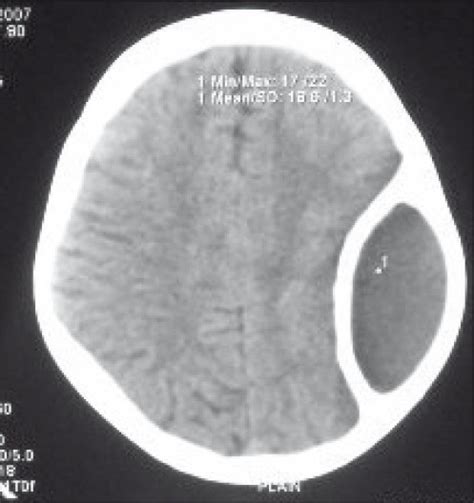 Ct Scan Axial Cuts Showing Extradural Hematoma Surrounding