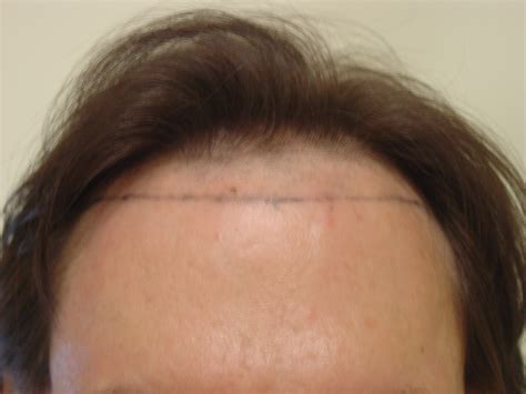 Before & After Photos - Dallas Hair Transplant - Armani Medical