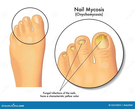 Nail mycosis stock vector. Illustration of onychomycosis - 52510925