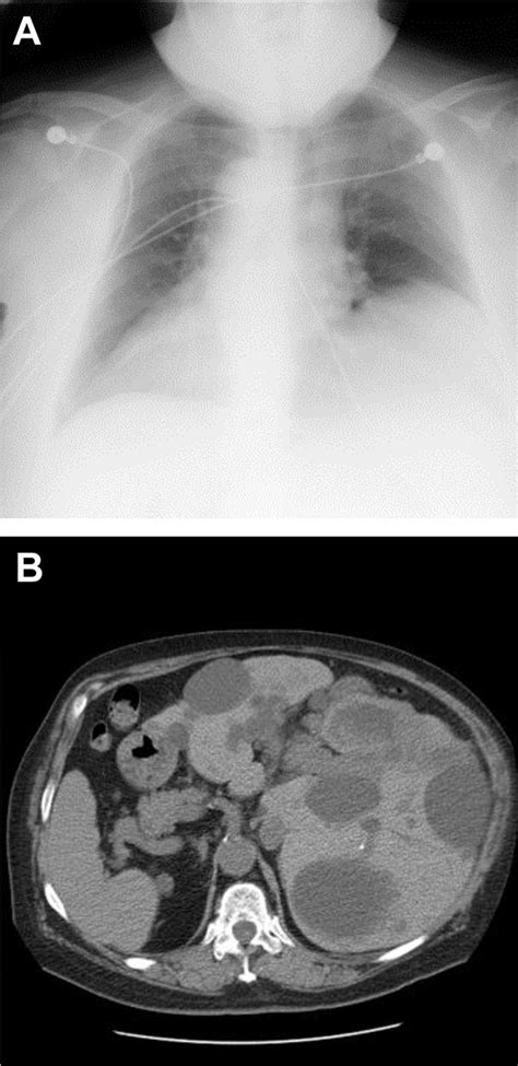 A Radiograph Of The Chest Shows Dextrocardia And Elevated Left