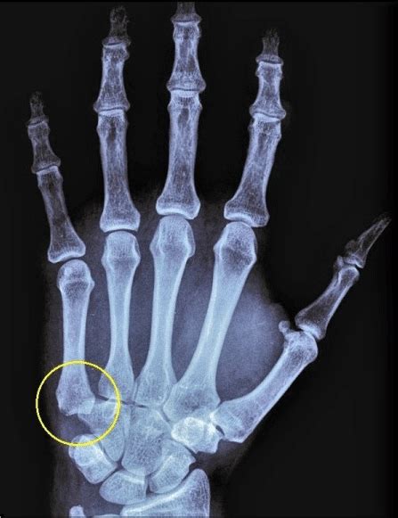 Carpometacarpal Joint Dislocation