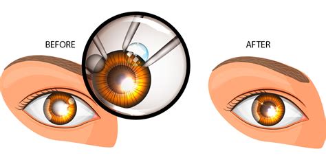 Cost Of Toric Lenses For Cataract Surgery