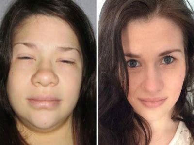 Hypothyroidism Face Before And After