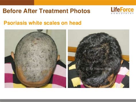 Psoriasis on Scalp & Head Photos: Before After Treatment Pictures