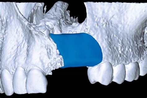 Reconstruction Of A Unilateral Alveolar Cleft Using A Customized