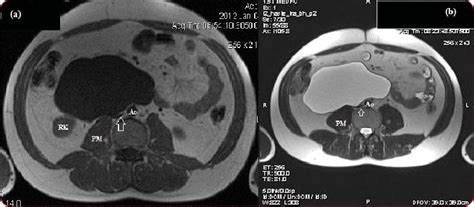 Magnetic Resonance Imaging Of The Abdomen Axial T1 A And T2 B