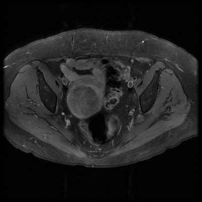 Radiology Cases: Lumbar Plexopathy