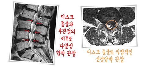 허리 통증 서울베스트정형외과의원