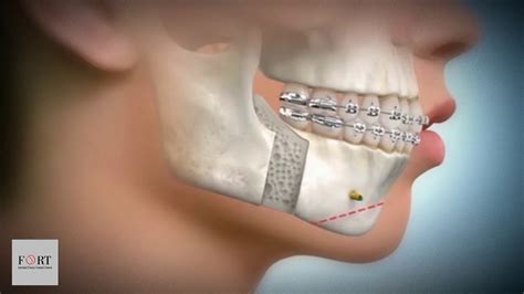 Orthognathic Surgery Dental Implant Procedure Youtube