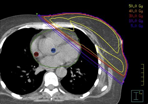 Risk Of Pacemaker Or Implantable Cardioverter Defibrillator After