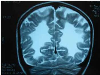 Sindrome De Lorenzo - Fisio Unec: Adrenoleucodistrofia " Óleo de Lorenzo"