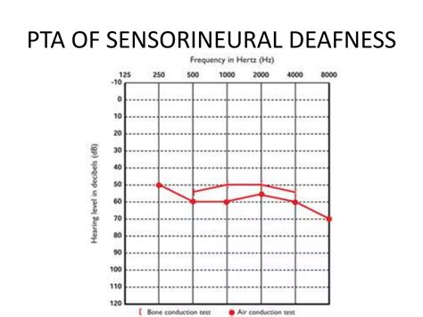 Pure Tone Audiometry Ppt