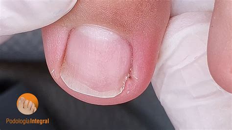 12 Year Old Patient Who Presented A Defective Nail Clipping Done By