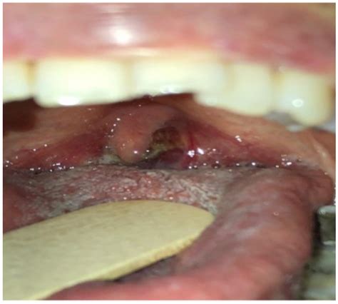 Sarcoma De Kaposi En Orofaringe En Paciente Postrasplante Renal Y