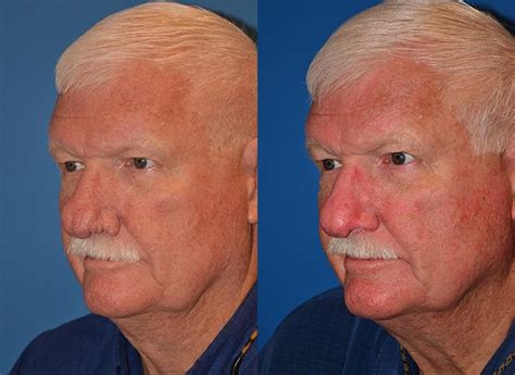 Rhinophyma Photos | Melbourne, FL | Patient 29613