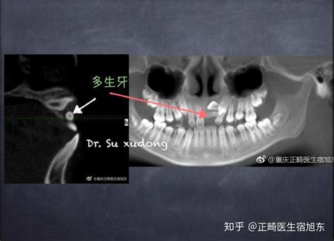 孩子的门牙长不出来怎么办 知乎