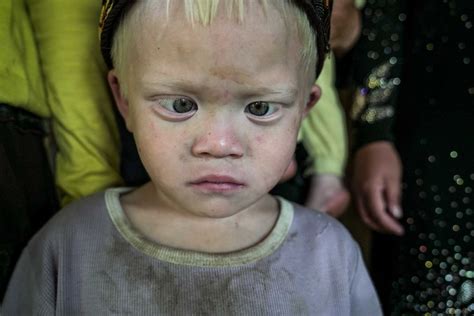 Its Hard Being White Indonesias Albino Village Abc News