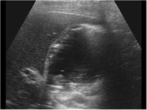 Abdomen and retroperitoneum | 1.2 Gallbladder and bile ducts : Case 1.2.6 Gallbladder ...