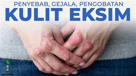 Cara Mengobati Penyakit Kulit Eksim Dermatitis Atopik Penyebab